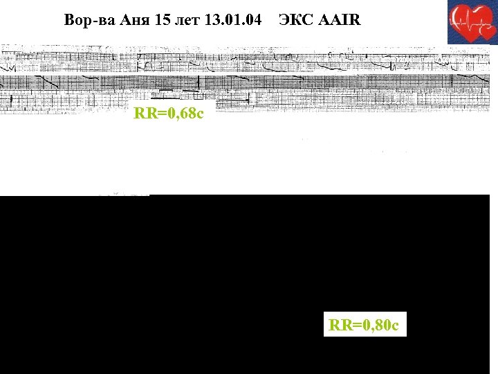 Вор-ва Аня 15 лет 13. 01. 04 ЭКС ААIR RR=0, 68 с RR=0, 80