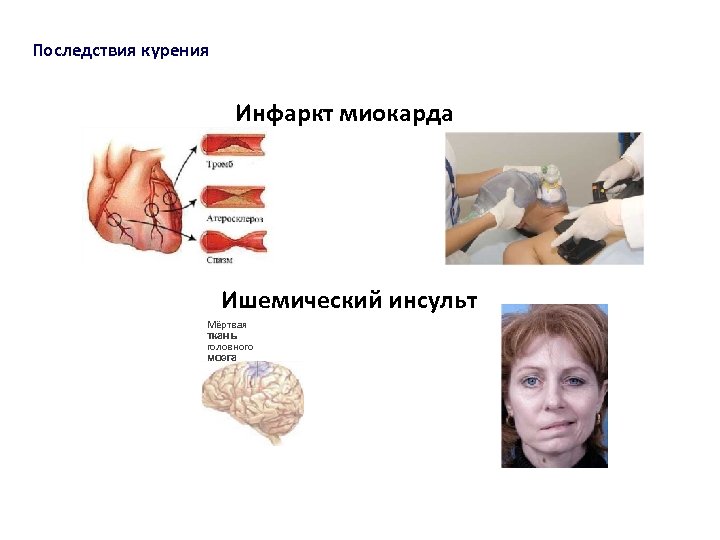 Последствия курения Инфаркт миокарда Ишемический инсульт Мёртвая ткань головного мозга 