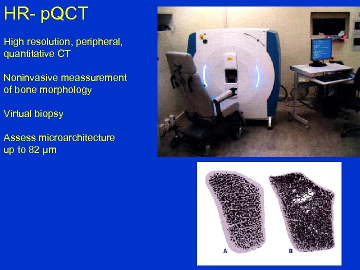 HR- p. QCT High resolution, peripheral, quantitative CT Noninvasive meassurement of bone morphology Virtual