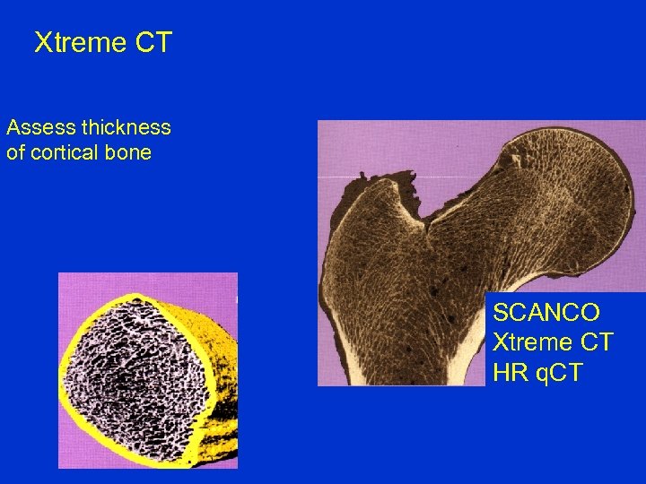 Xtreme CT Assess thickness of cortical bone SCANCO Xtreme CT HR q. CT 
