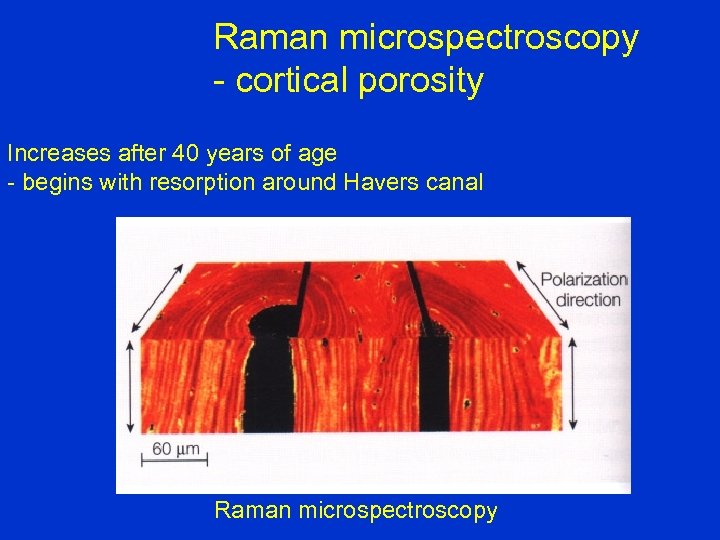 Raman microspectroscopy - cortical porosity Increases after 40 years of age - begins with