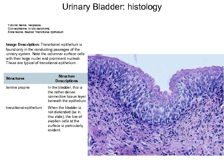 Urinary Bladder: histology Tutorial Name: Neoplasia Concept. Name: In situ carcinoma Slide Name: Bladder
