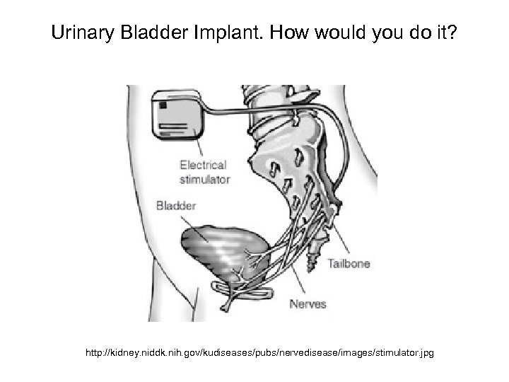 Urinary Bladder Implant. How would you do it? http: //kidney. niddk. nih. gov/kudiseases/pubs/nervedisease/images/stimulator. jpg