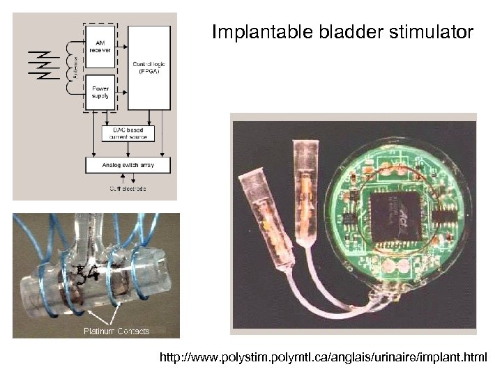 Implantable bladder stimulator http: //www. polystim. polymtl. ca/anglais/urinaire/implant. html 