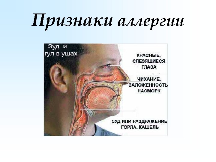Признаки аллергии 