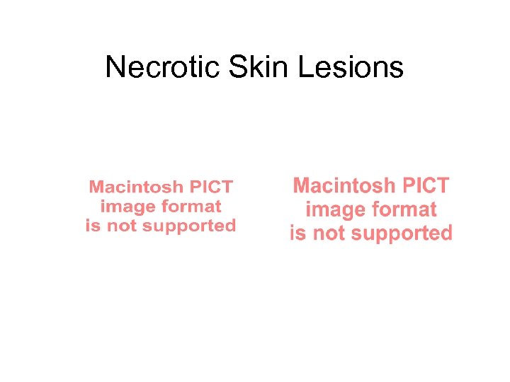 Necrotic Skin Lesions 