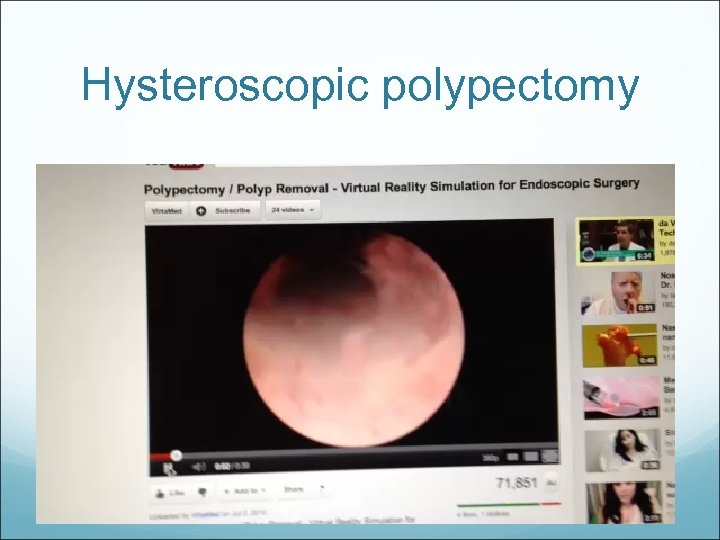 Hysteroscopic polypectomy 