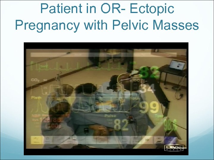 Patient in OR- Ectopic Pregnancy with Pelvic Masses 