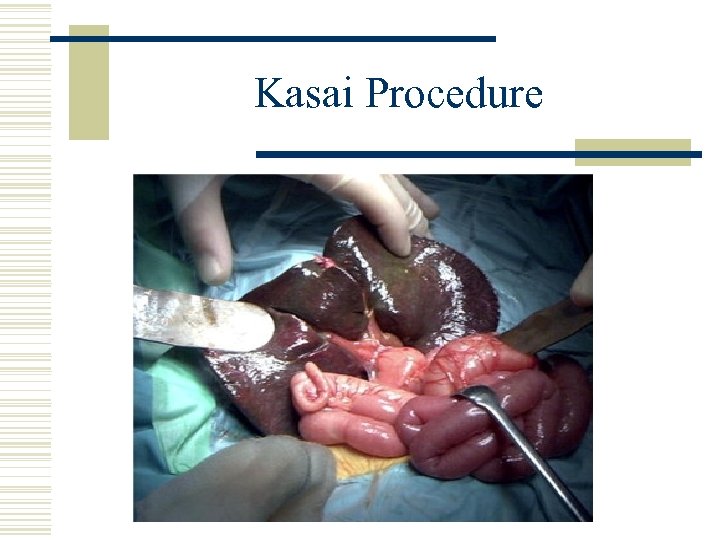 Kasai Procedure 