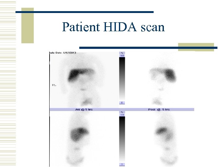 Patient HIDA scan 