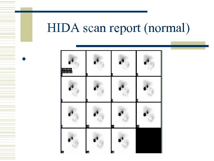 HIDA scan report (normal) w 