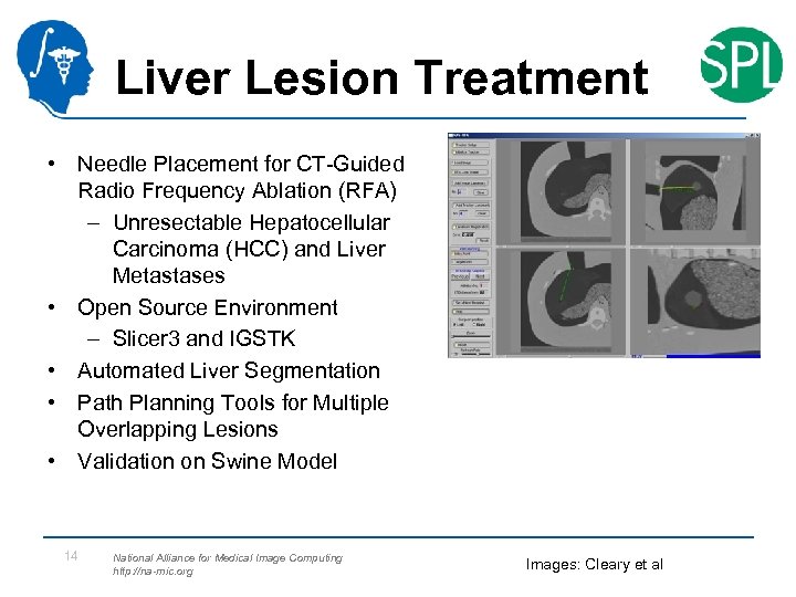 Liver Lesion Treatment • Needle Placement for CT-Guided Radio Frequency Ablation (RFA) – Unresectable