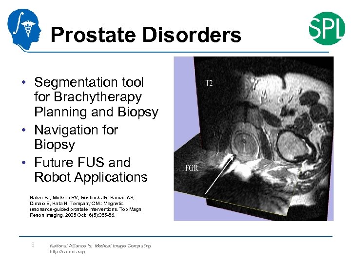 Prostate Disorders • Segmentation tool for Brachytherapy Planning and Biopsy • Navigation for Biopsy