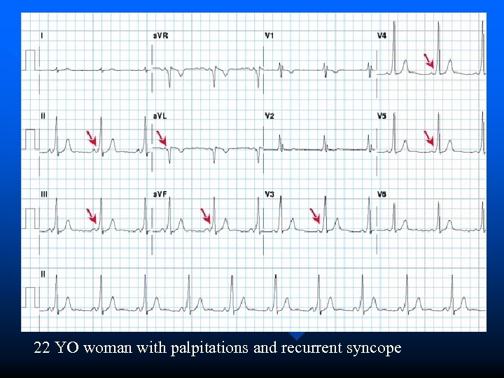 22 YO woman with palpitations and recurrent syncope 