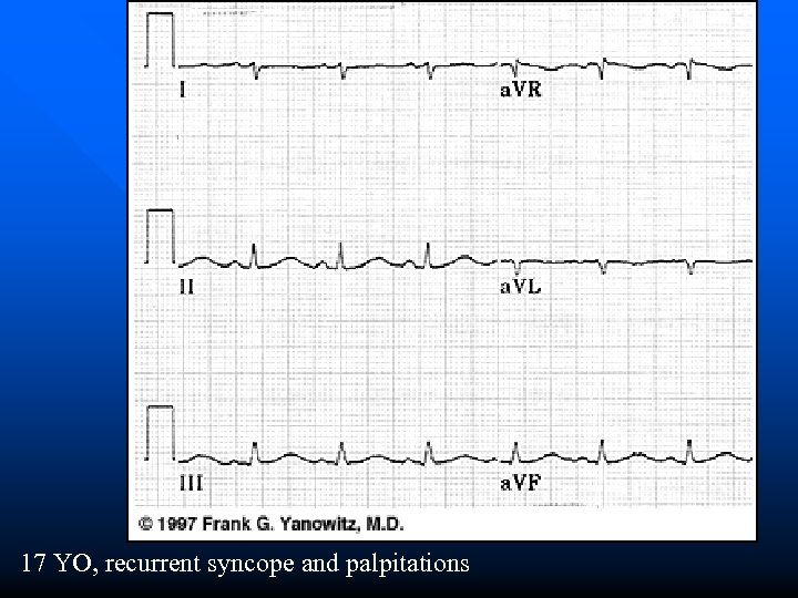 17 YO, recurrent syncope and palpitations 