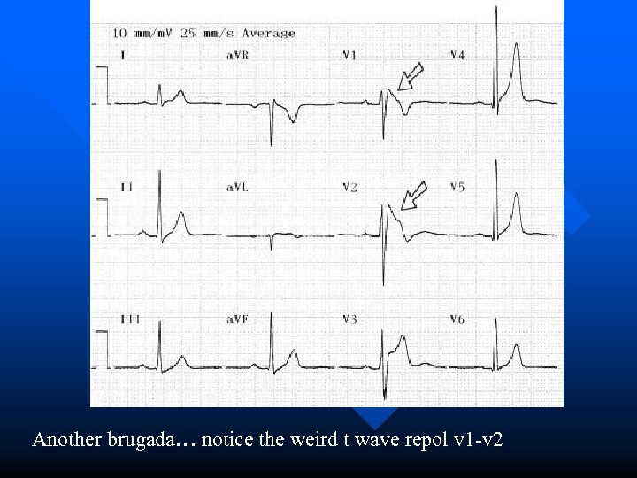 Another brugada… notice the weird t wave repol v 1 -v 2 