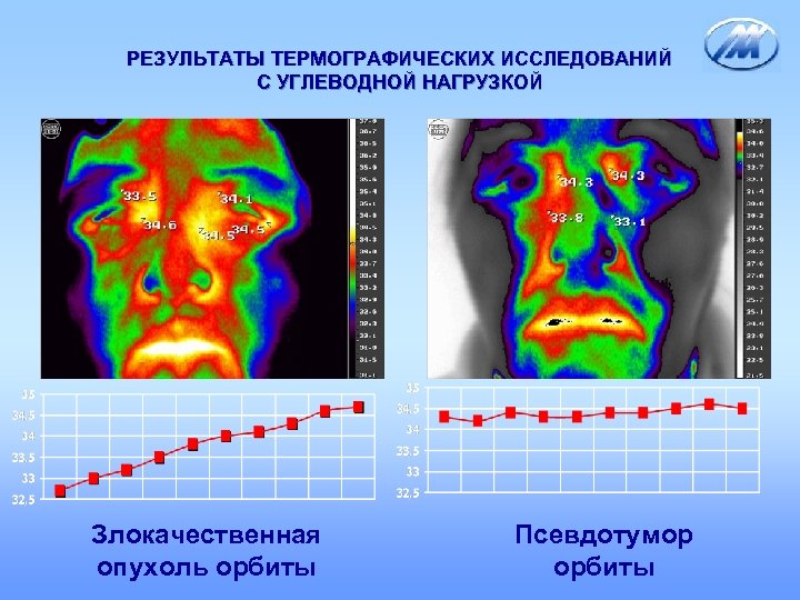 РЕЗУЛЬТАТЫ ТЕРМОГРАФИЧЕСКИХ ИССЛЕДОВАНИЙ С УГЛЕВОДНОЙ НАГРУЗКОЙ Злокачественная опухоль орбиты Псевдотумор орбиты 
