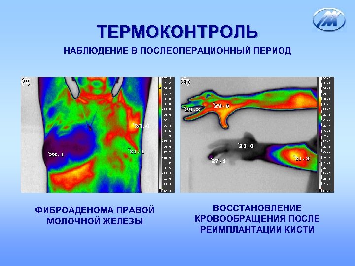 ТЕРМОКОНТРОЛЬ НАБЛЮДЕНИЕ В ПОСЛЕОПЕРАЦИОННЫЙ ПЕРИОД ФИБРОАДЕНОМА ПРАВОЙ МОЛОЧНОЙ ЖЕЛЕЗЫ ВОССТАНОВЛЕНИЕ КРОВООБРАЩЕНИЯ ПОСЛЕ РЕИМПЛАНТАЦИИ КИСТИ