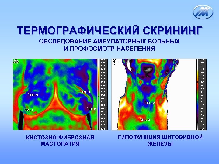ТЕРМОГРАФИЧЕСКИЙ СКРИНИНГ ОБСЛЕДОВАНИЕ АМБУЛАТОРНЫХ БОЛЬНЫХ И ПРОФОСМОТР НАСЕЛЕНИЯ КИСТОЗНО-ФИБРОЗНАЯ МАСТОПАТИЯ ГИПОФУНКЦИЯ ЩИТОВИДНОЙ ЖЕЛЕЗЫ 