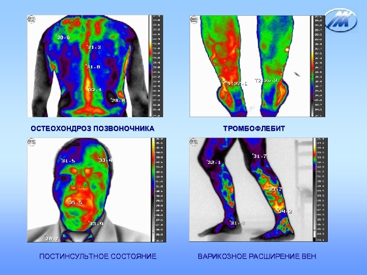 ОСТЕОХОНДРОЗ ПОЗВОНОЧНИКА ПОСТИНСУЛЬТНОЕ СОСТОЯНИЕ ТРОМБОФЛЕБИТ ВАРИКОЗНОЕ РАСШИРЕНИЕ ВЕН 