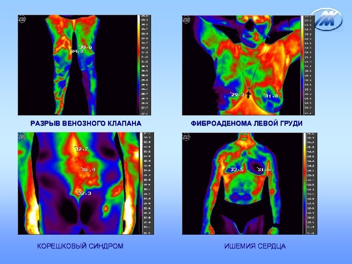 РАЗРЫВ ВЕНОЗНОГО КЛАПАНА КОРЕШКОВЫЙ СИНДРОМ ФИБРОАДЕНОМА ЛЕВОЙ ГРУДИ ИШЕМИЯ СЕРДЦА 
