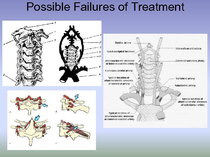 Possible Failures of Treatment 