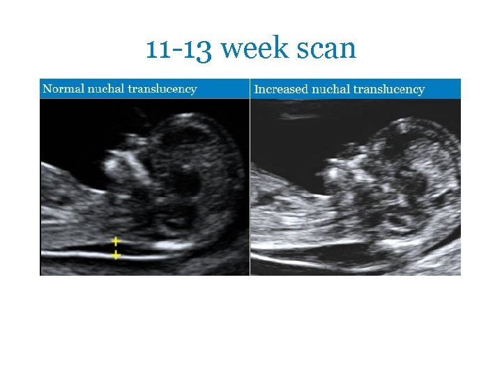 11 -13 week scan 