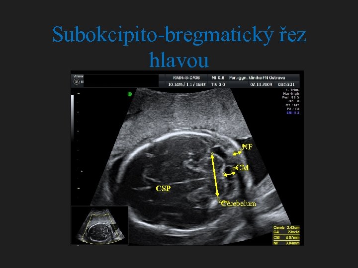 Subokcipito-bregmatický řez hlavou NF CM CSP Cerebelum 