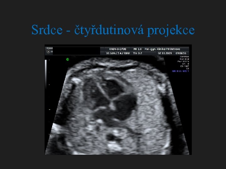 Srdce - čtyřdutinová projekce 