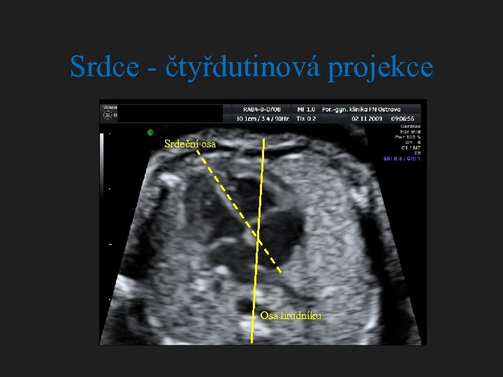 Srdce - čtyřdutinová projekce Srdeční osa Osa hrudníku 