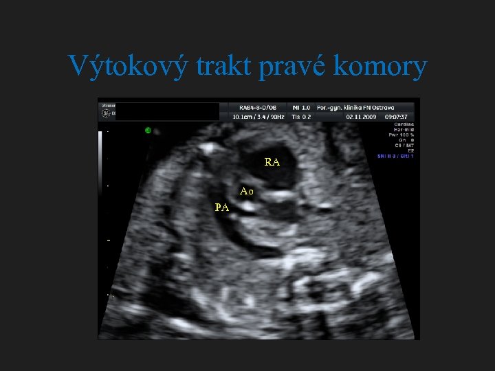 Výtokový trakt pravé komory RA Ao PA 