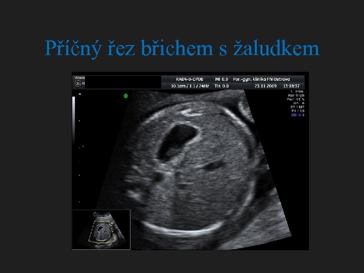 Příčný řez břichem s žaludkem 