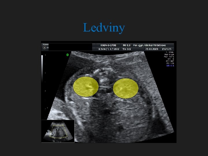 Ledviny 