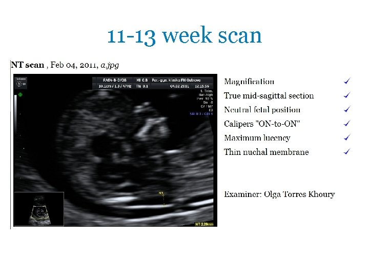 11 -13 week scan 