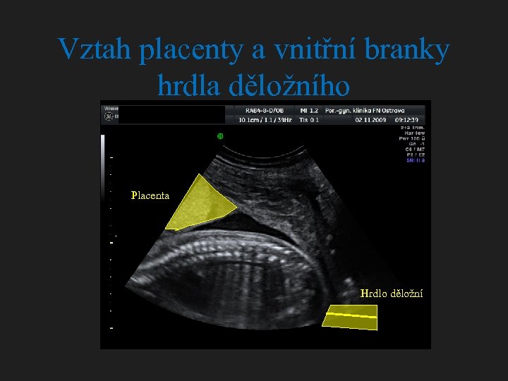 Vztah placenty a vnitřní branky hrdla děložního Placenta Hrdlo děložní 