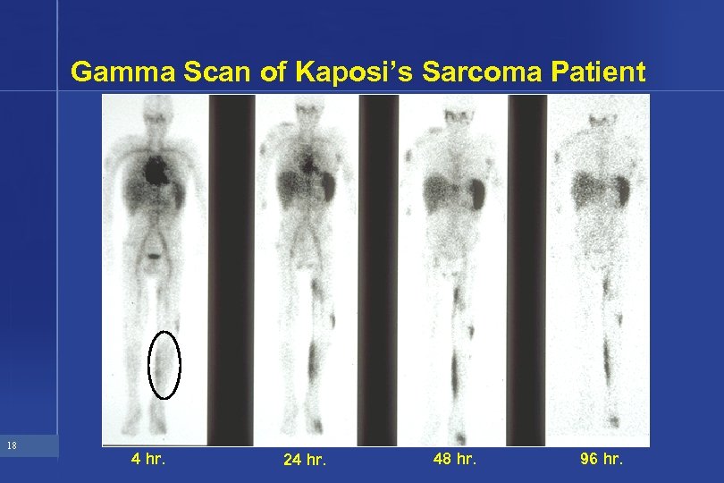 Gamma Scan of Kaposi’s Sarcoma Patient 18 4 hr. 24 hr. 48 hr. 96