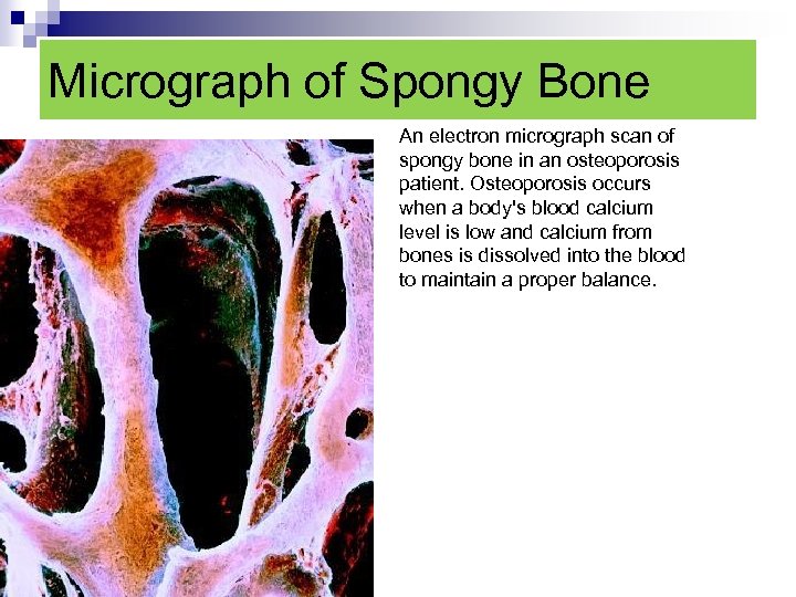 Micrograph of Spongy Bone An electron micrograph scan of spongy bone in an osteoporosis