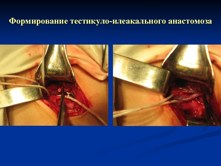 Формирование тестикуло-илеакального анастомоза 