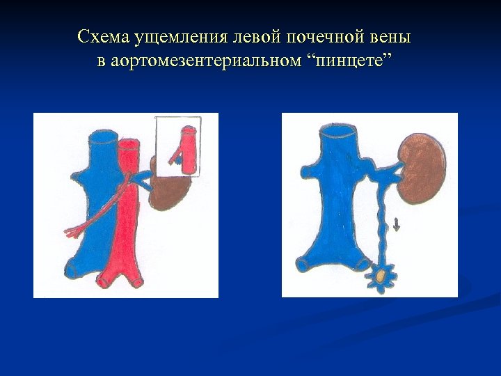 Схема ущемления левой почечной вены в аортомезентериальном “пинцете” 