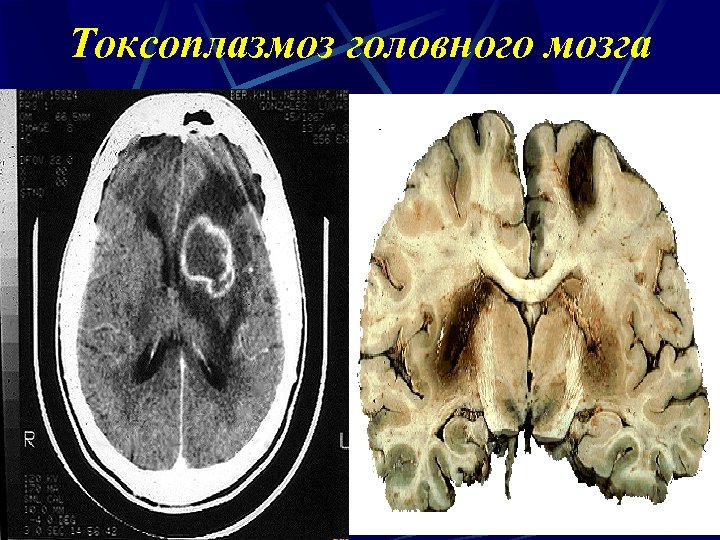 Токсоплазмоз головного мозга 