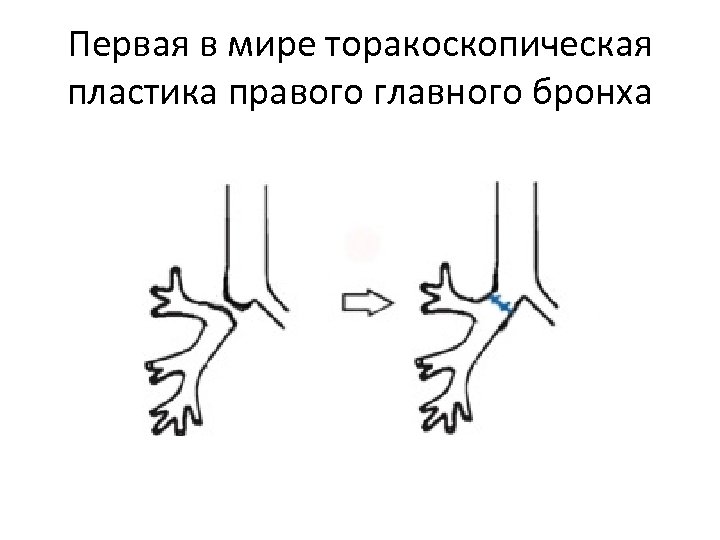 Первая в мире торакоскопическая пластика правого главного бронха 