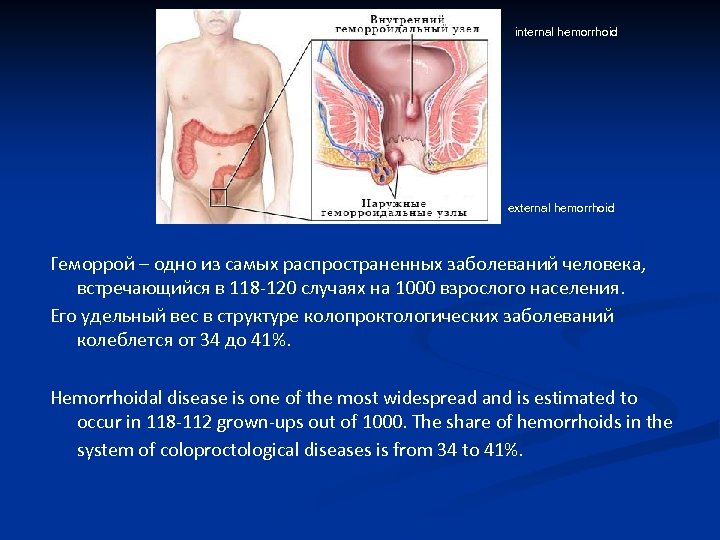 internal hemorrhoid external hemorrhoid Геморрой – одно из самых распространенных заболеваний человека, встречающийся в
