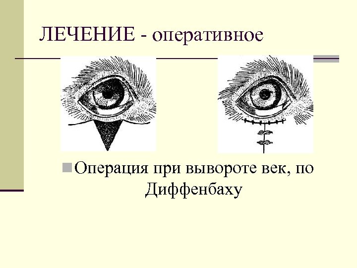 ЛЕЧЕНИЕ - оперативное n Операция при вывороте век, по Диффенбаху 