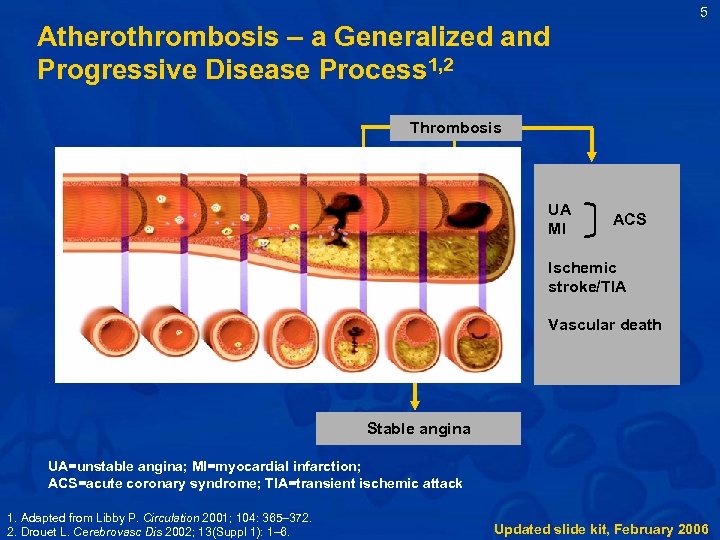 5 Atherothrombosis – a Generalized and Progressive Disease Process 1, 2 Thrombosis UA MI