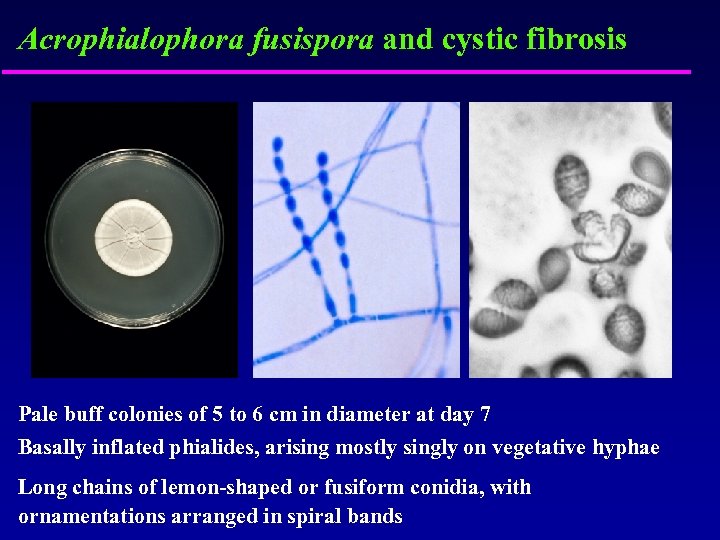 Acrophialophora fusispora and cystic fibrosis Pale buff colonies of 5 to 6 cm in