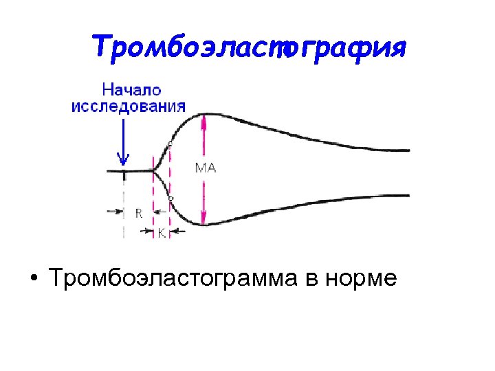 Тромбоэластография • Тромбоэластограмма в норме 