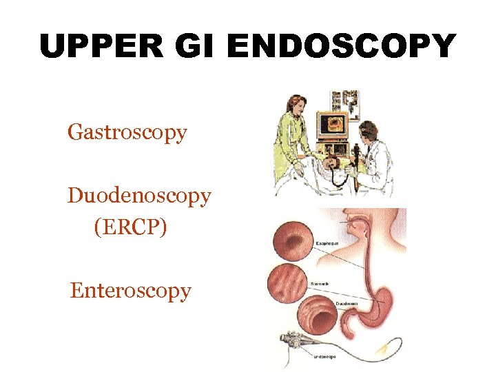 UPPER GI ENDOSCOPY Gastroscopy Duodenoscopy (ERCP) Enteroscopy 