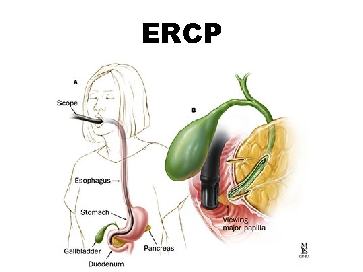 ERCP 