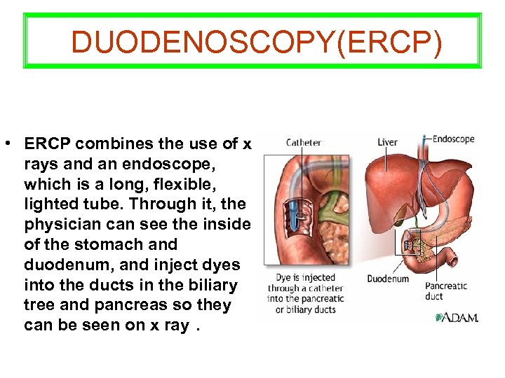 DUODENOSCOPY(ERCP) • ERCP combines the use of x rays and an endoscope, which is