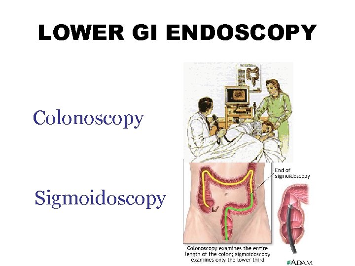 LOWER GI ENDOSCOPY Colonoscopy Sigmoidoscopy 